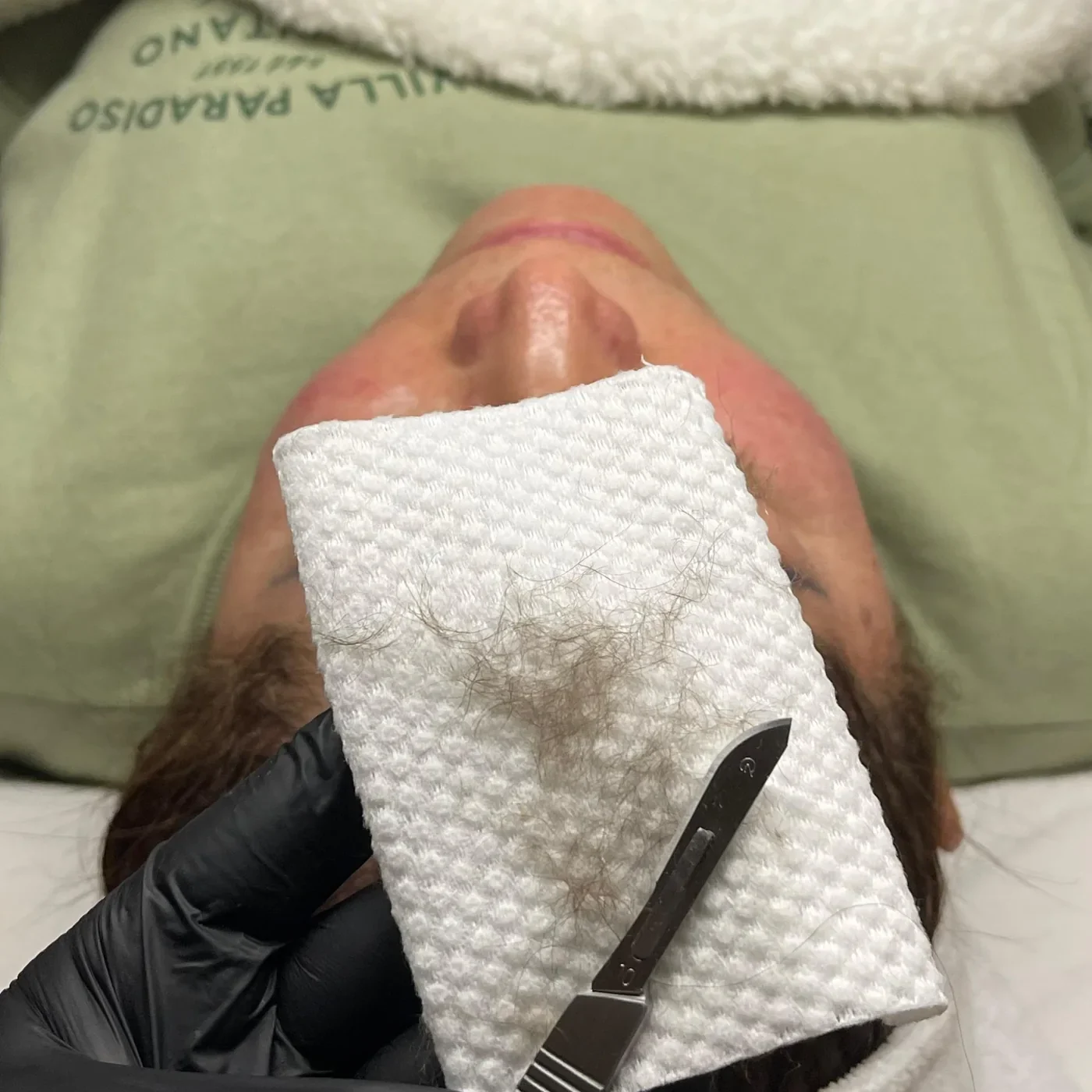 Dermaplaning facial