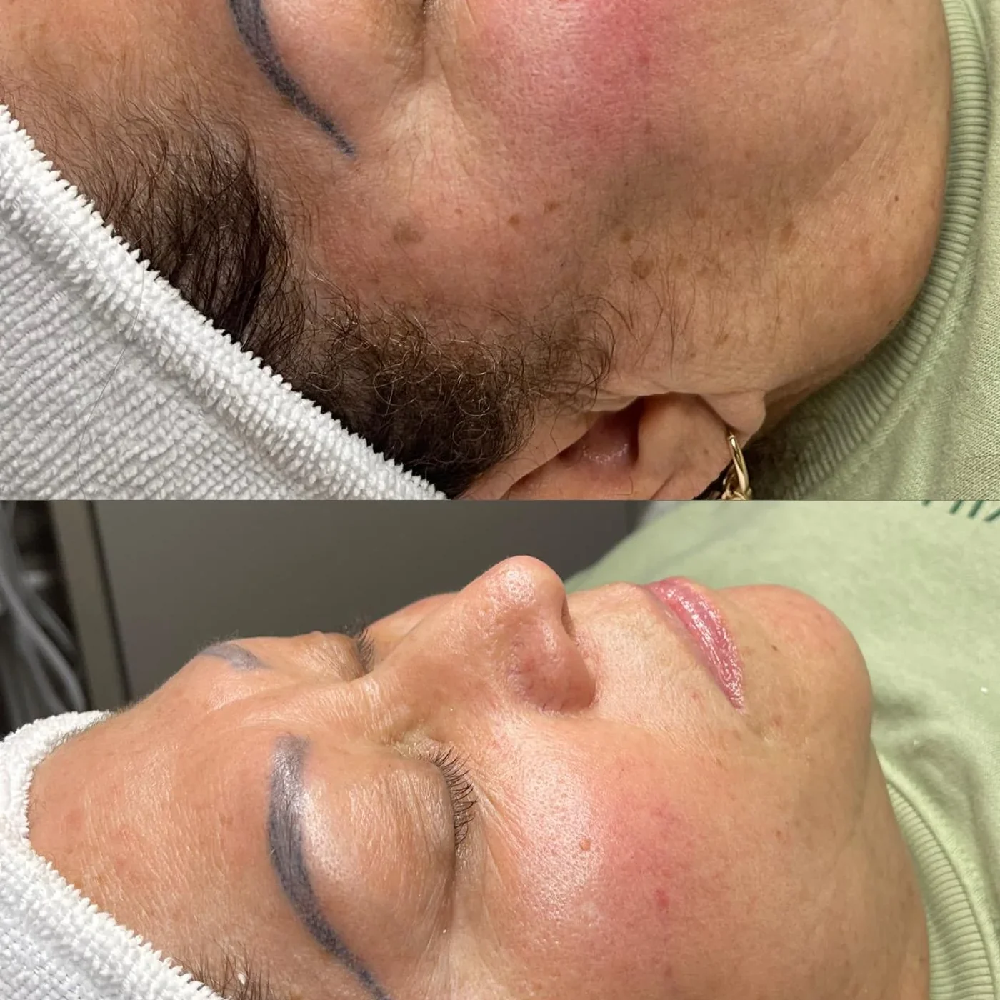 Dermaplaning facial