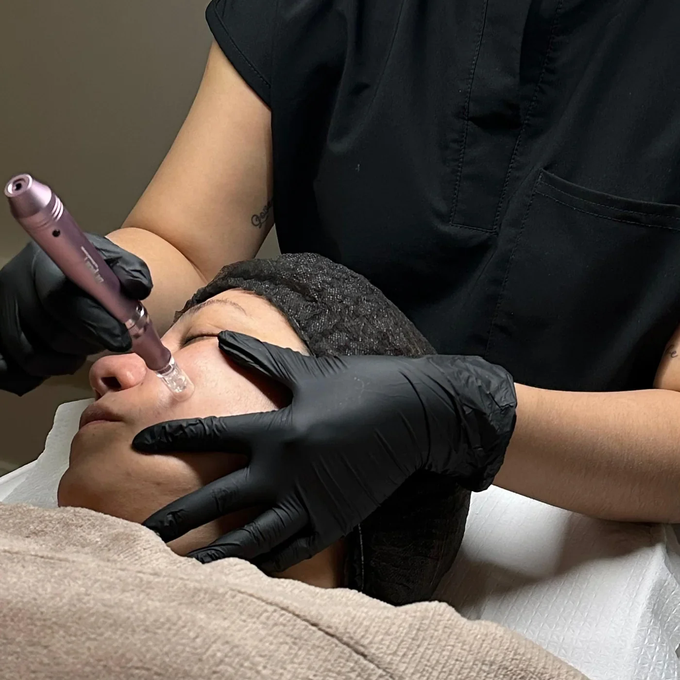 Microneedling facial personalizado