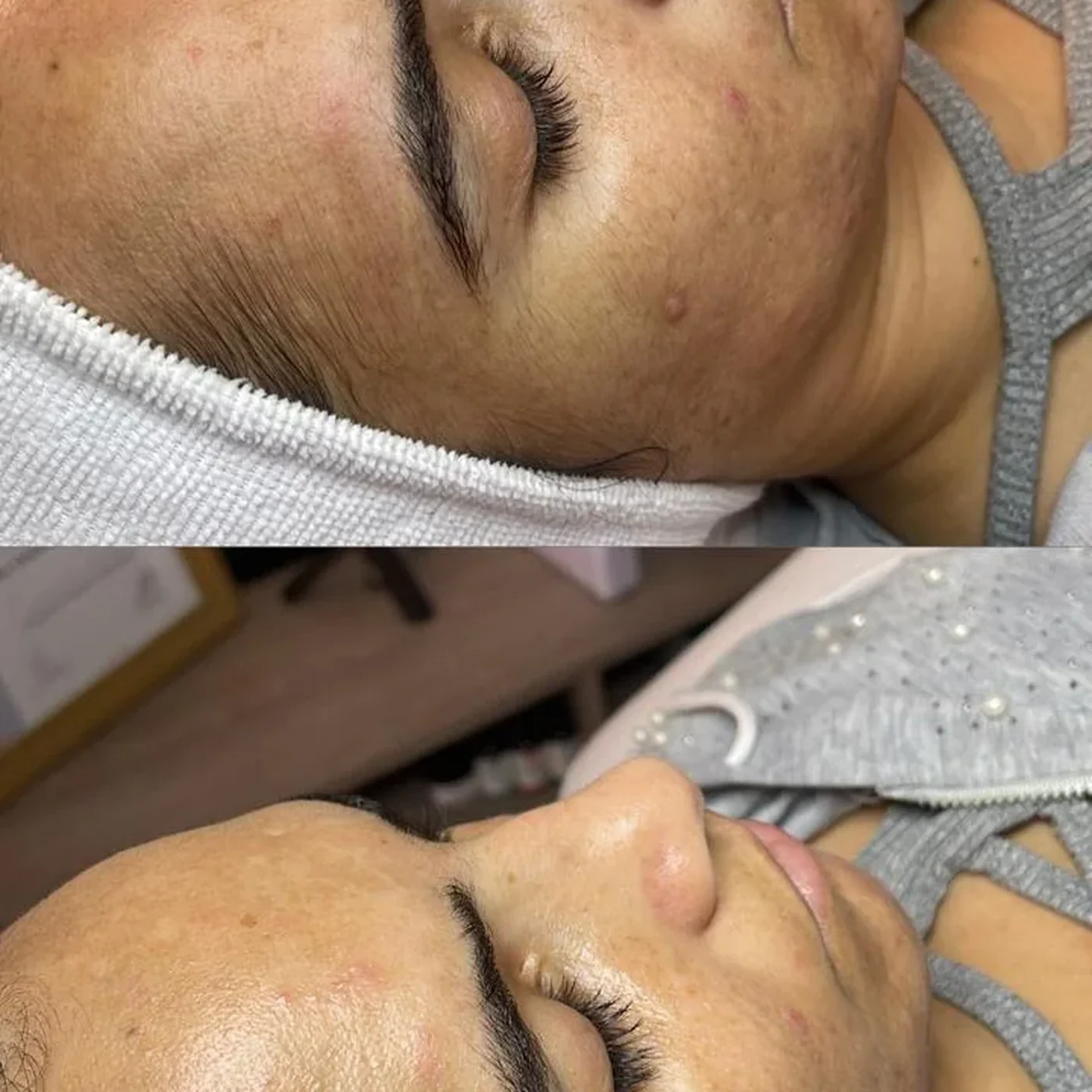 Facial Uniformidad del Tono